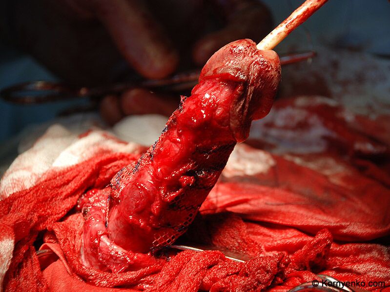 installazione di una matrice di collagene per l’ingrandimento del pene