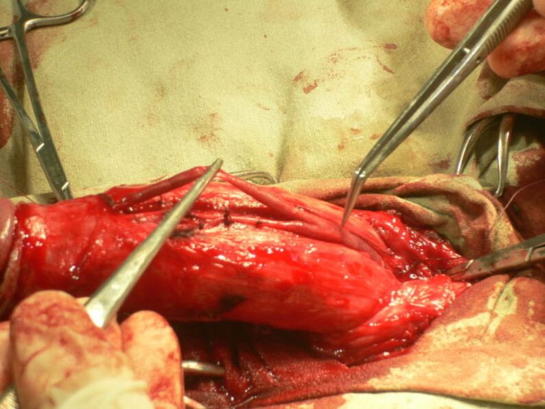 lipofilling del pene per l'ingrandimento