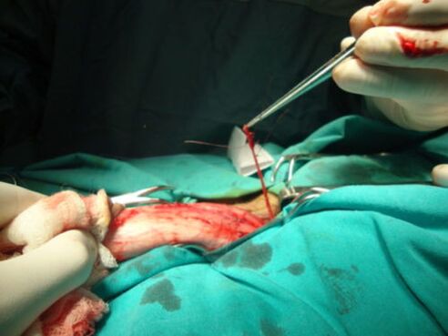 intervento chirurgico per l’ingrandimento del pene