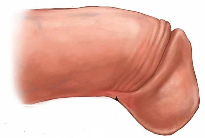 come ingrandire il glande del pene